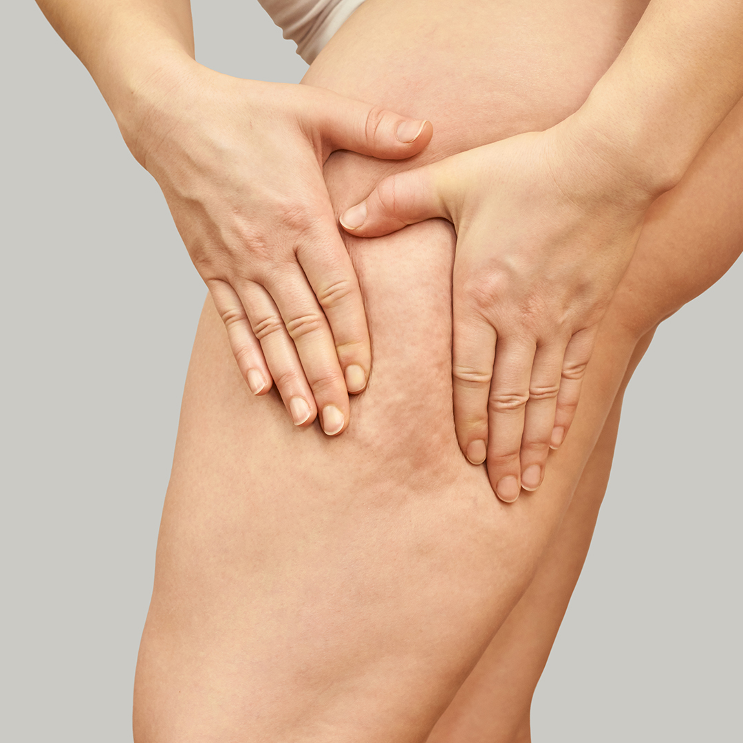 Imagen sobre tratamientos corporales para la celulitis.
