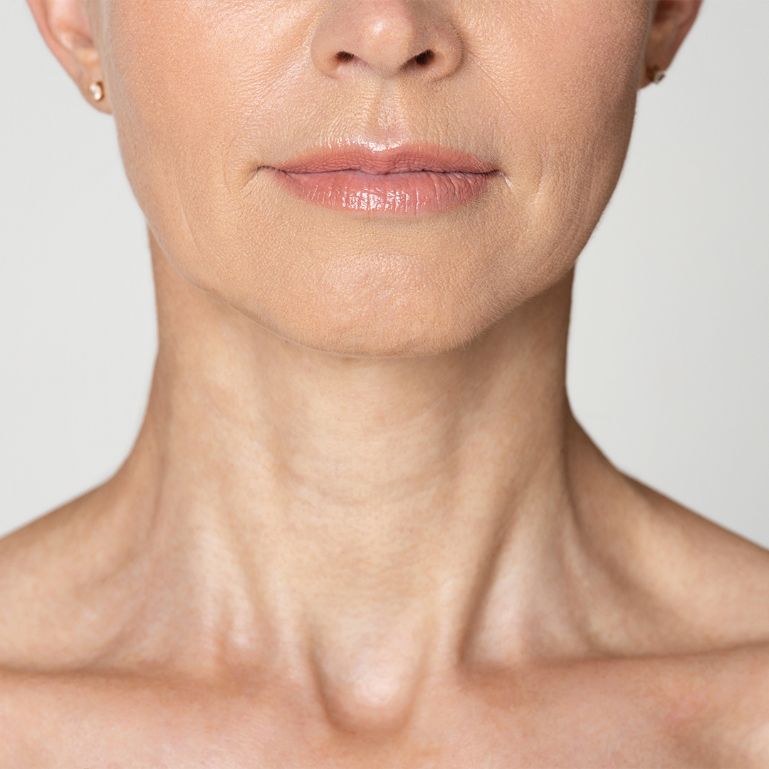 Imagen sobre tratamientos médico estéticos para cuello.